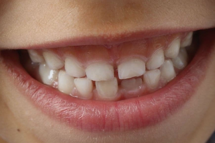 Denti da latte e parodontiti