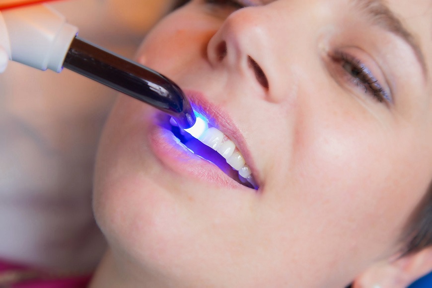 Laser in odontoiatria5