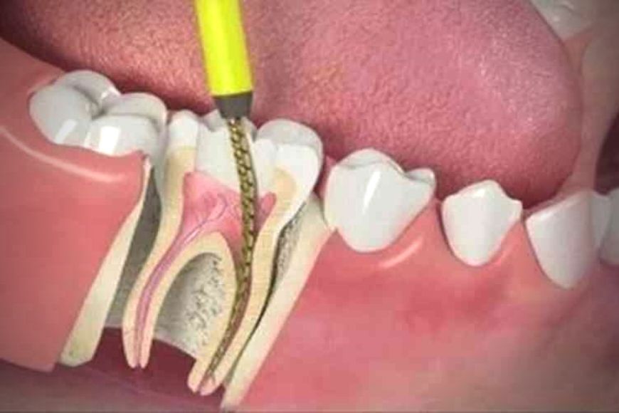 devitalizzazione denti 02